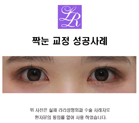 Correcting Uneven Eyes with a Double Eyelid on Only One Side image 3