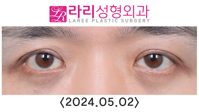 [Lari Plastic Surgery] Double Eyelid Removal Surgery and Upper Eyelid Fat Grafting Surgery: Comparing Recovery and Swelling Over 6 Months image 3