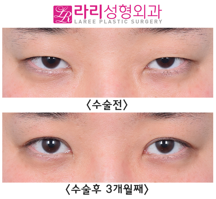 [Lari Plastic Surgery] Before and After Incisional Ptosis Correction Surgery for a Soft Impression Without Feeling Overdone image 1
