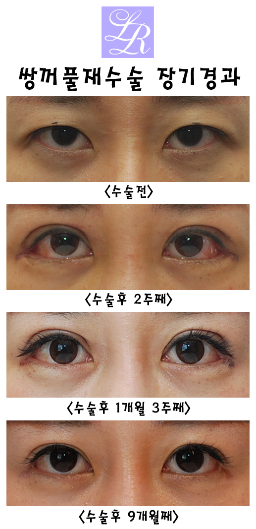 쌍꺼풀재수술 왜 필요한거죠? 라인교정, 붓기, 경과, 흉터교정 관련 이미지 3