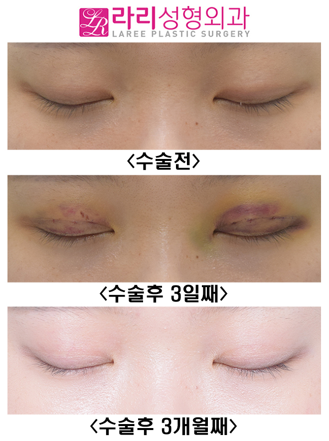 [라리성형외과] 흉터 없이 말끔한 매몰 쌍수 어때요? 관련 이미지 2