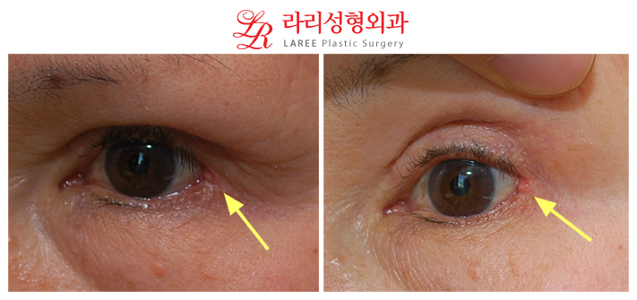 At Lari, Revision Epicanthoplasty Corrects Outer Canthotomy Scars! image 1