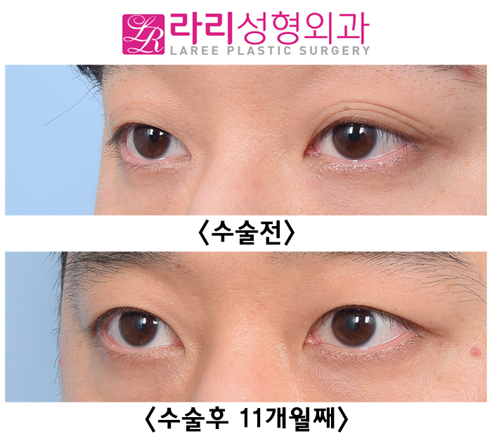 [Lari Plastic Surgery] Surgery Before-and-After Photos for Removing Multiple Eyelid Folds That Are Hard to Leave Alone image 3