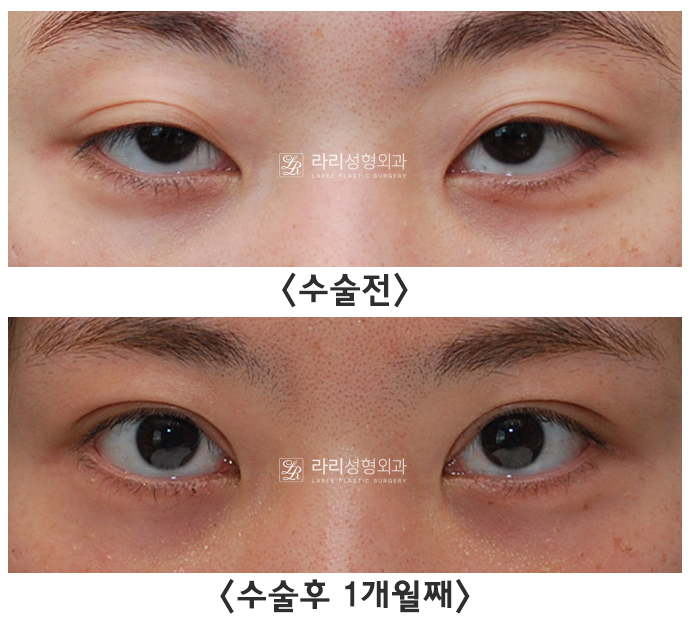 [라리성형외과] 안검하수 눈의 눈매교정이 어려운 이유 ?!! (Point ; 헤링의 법칙) 관련 이미지 3