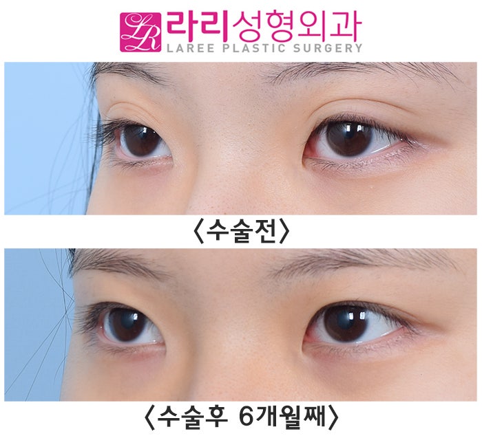[라리성형외과] Revision Double-Eyelid Surgery if Buried-Suture Double Eyelids Come Undone? No, No—Removing the Double Eyelid! image 4