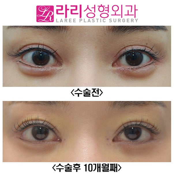 [Lari Plastic Surgery] Before-and-After Photos of Revision Canthoplasty for Downward Outer Eye Corners image 1