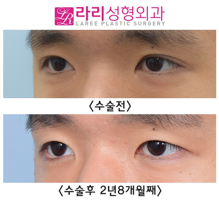 [Lari Plastic Surgery] Removing Eyelid Creases: Eyes Not Closing Fully, Side Effects, Recovery, Before-and-After Photos image 5