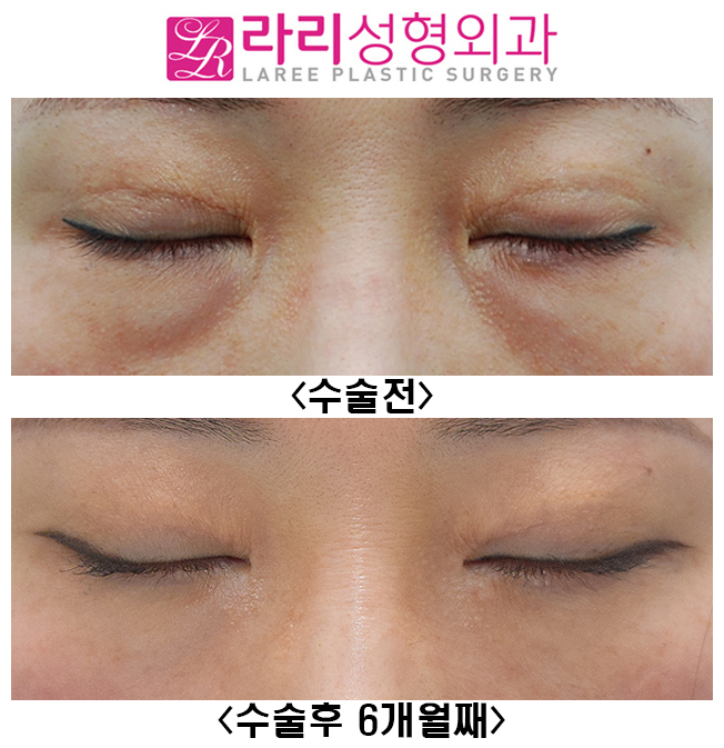 [라리성형외과] 쌍꺼풀재수술, 앞트임재수술, 눈밑지방재배치재수술 전후사진 관련 이미지 4