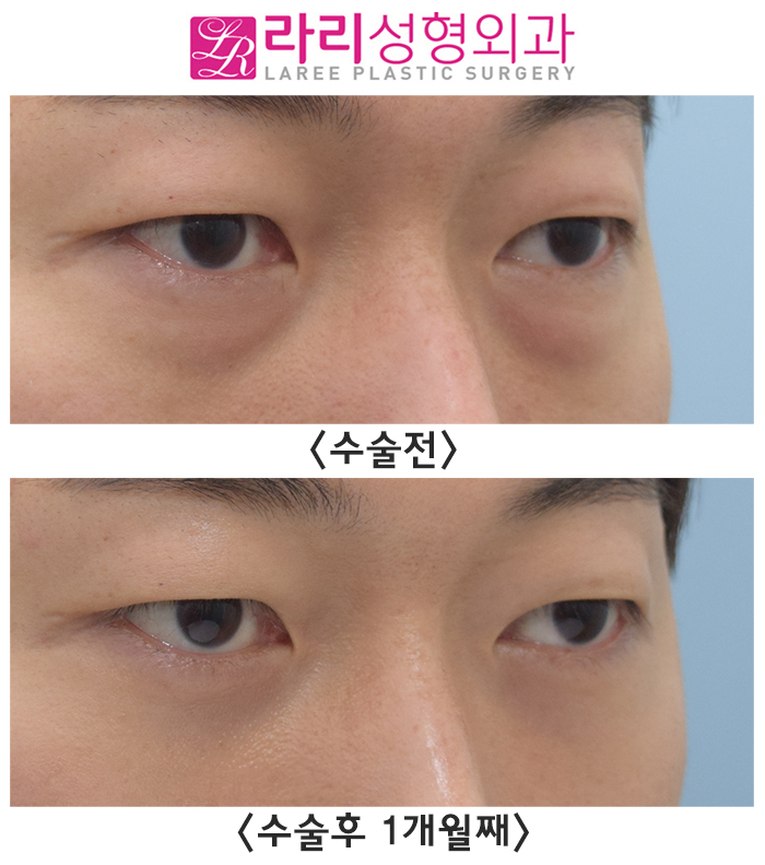 [라리성형외과] 간단해 보이지만 그렇지 않은 눈밑지방재배치수술 전후사진 관련 이미지 3