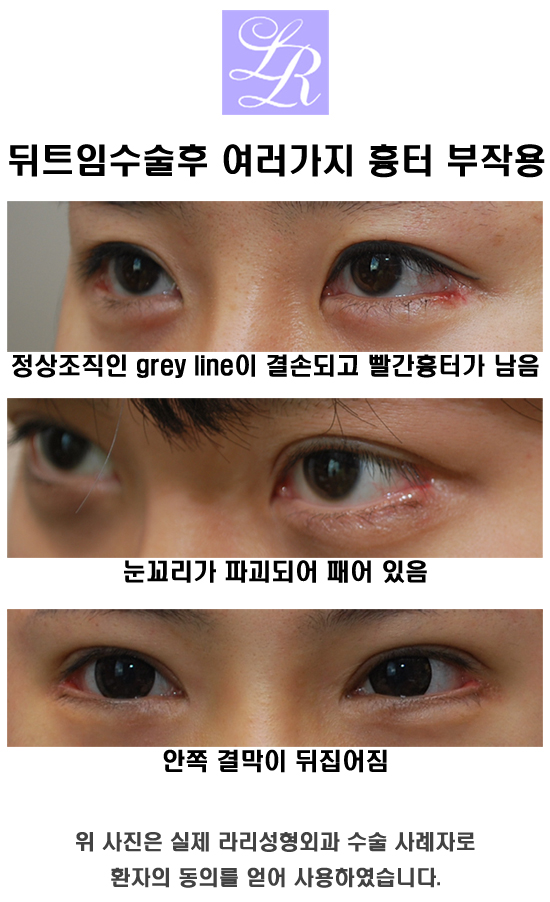 눈이 작아지지 않는 뒤트임재수술 관련 이미지 1