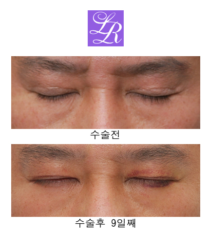 쌍꺼풀 푸는 수술/ 없애기 차이점은? 관련 이미지 5