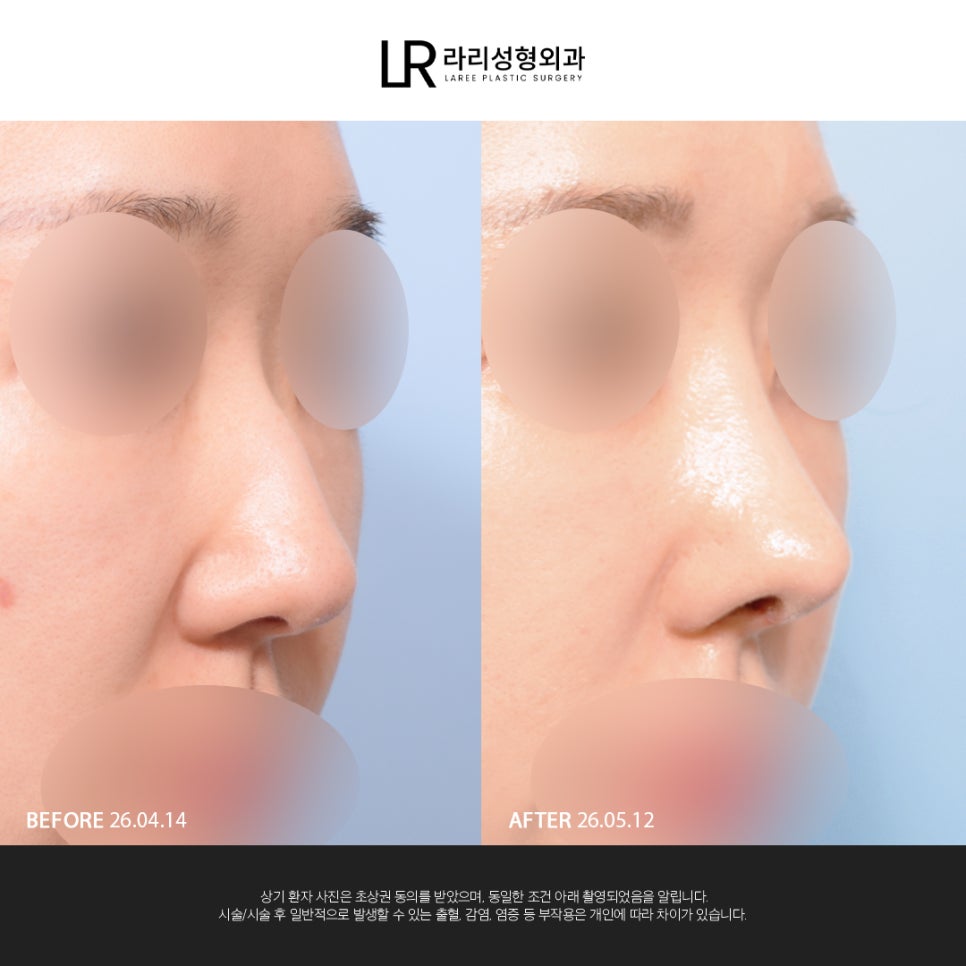 [Lari Plastic Surgery] If You Are Considering Nose Surgery, Do Not Get Nose Thread-Lifting Procedures Like Misko / Hiko!! image 7