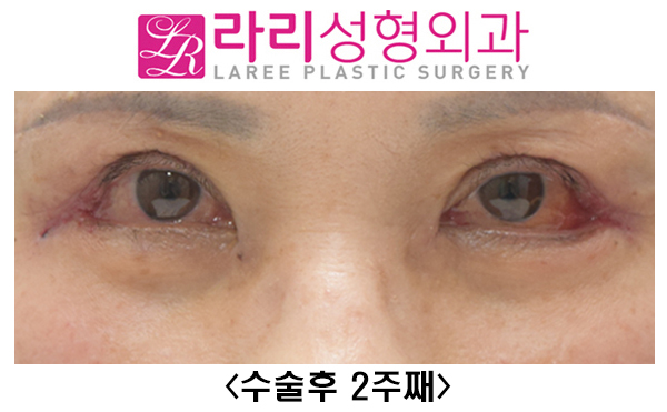 [Lari Plastic Surgery] Upper eyelid surgery, non-epicanthic inner corner surgery, revision outer corner surgery, and lower eyelid fat repositioning can all be done at once. Recovery with good results is possible! image 2