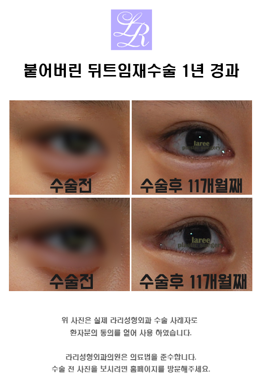 뒤트임재수술 - 안검내반 교정, 2주와 4개월, 1년 경과 관련 이미지 3