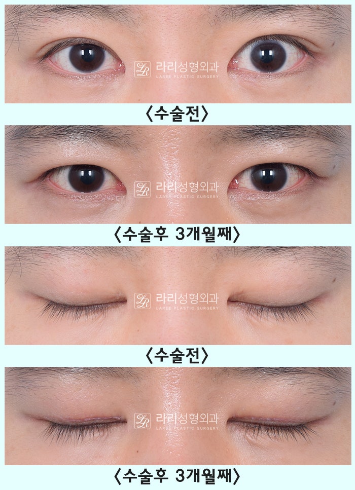[Lari Plastic Surgery] One-sided double eyelid surgery to correct uneven eyes: Is it possible to get double eyelids on only one eye? image 9