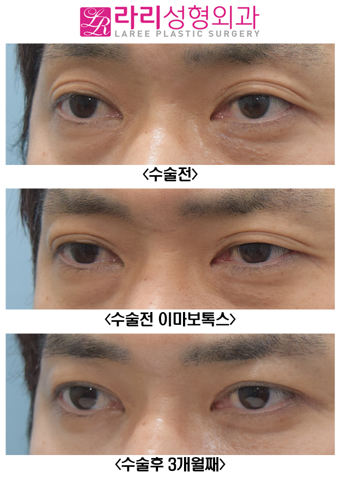 [라리성형외과] 여러겹 쌍꺼풀 제거 관련 이미지 4