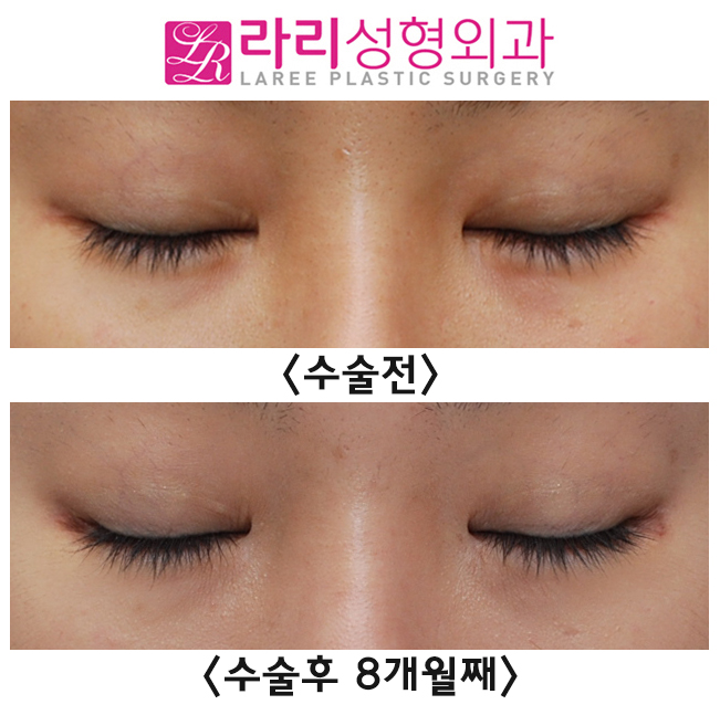 [라리성형외과] 벌어짐 없는 앞트임 미세복원 관련 이미지 4