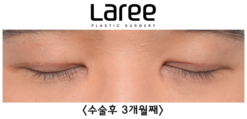 [Lari Plastic Surgery] Eyelid Correction Surgery and Upper Canthoplasty: Experiencing the Maximum Effect of Non-Double-Eyelid Eyelid Correction Without Medial Drooping image 8
