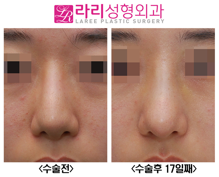 [라리성형외과] 꺾인 콧대 낮은 코끝 살리는 코재수술 관련 이미지 1