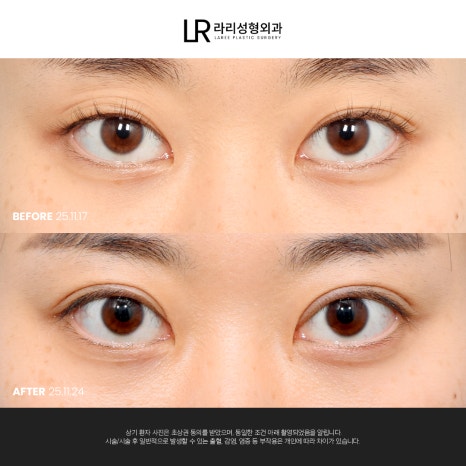 [라리성형외과] 눈 (재) 수술은 라리성형외과가 관련 이미지 11