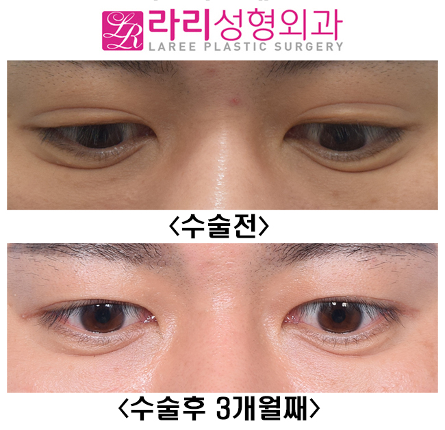 [라리성형외과] 원래 없었던 것처럼 보이는 자연쌍꺼풀없애기 관련 이미지 3