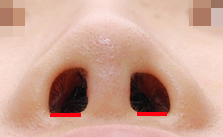 Short Upturned Nose Revision Surgery: Rib Cartilage Is Essential! (feat. Alar Reduction) image 5