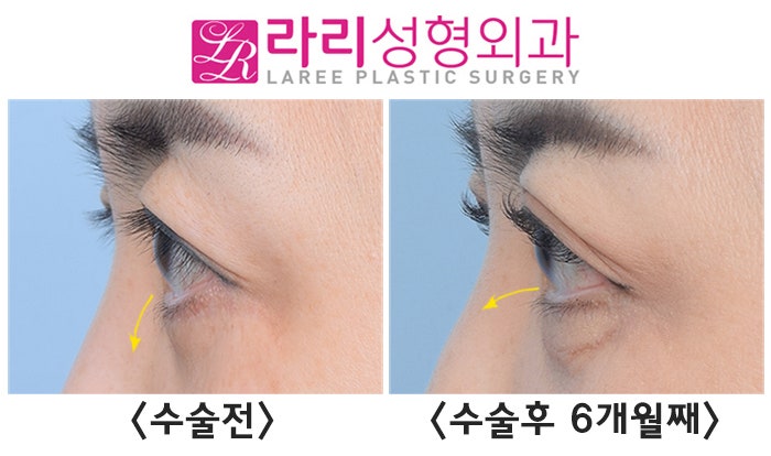 [라리성형외과] 안검내반과 안검외반, 무엇이 다를까 ? 관련 이미지 3