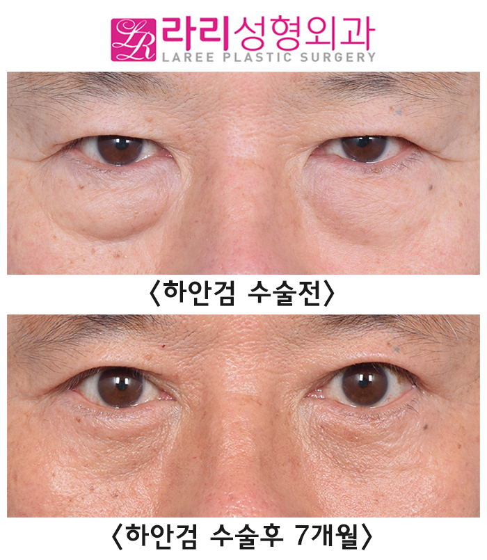 [Rari Plastic Surgery] The Most Common Complication of Lower Blepharoplasty: Lower Eyelid Ectropion image 1