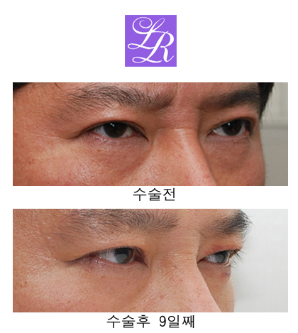 쌍꺼풀 푸는 수술/ 없애기 차이점은? 관련 이미지 6