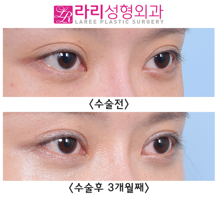 [라리성형외과] 쌍꺼풀재수술로 삼백안이 좋아지는 경우 관련 이미지 3