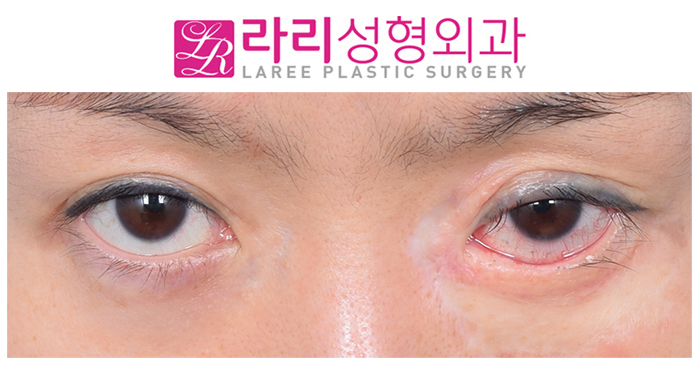 [Laree Plastic Surgery] If Ectropion Has Occurred, Let’s Find Out the Right Time for Correction image 2