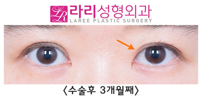 [Lari Plastic Surgery] Changes in Double Eyelid Line Over Time After Revision Surgery for Loosening Side Effects image 3