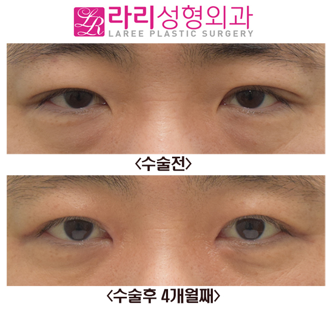 [Rari Plastic Surgery] Before-and-After Photos of Surgery to Remove the Double Eyelid Fold and Epicanthoplasty image 1