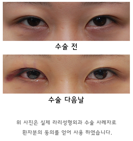 Swelling and Results Judged from Photos in Non-Incision Eye Correction Reviews image 9