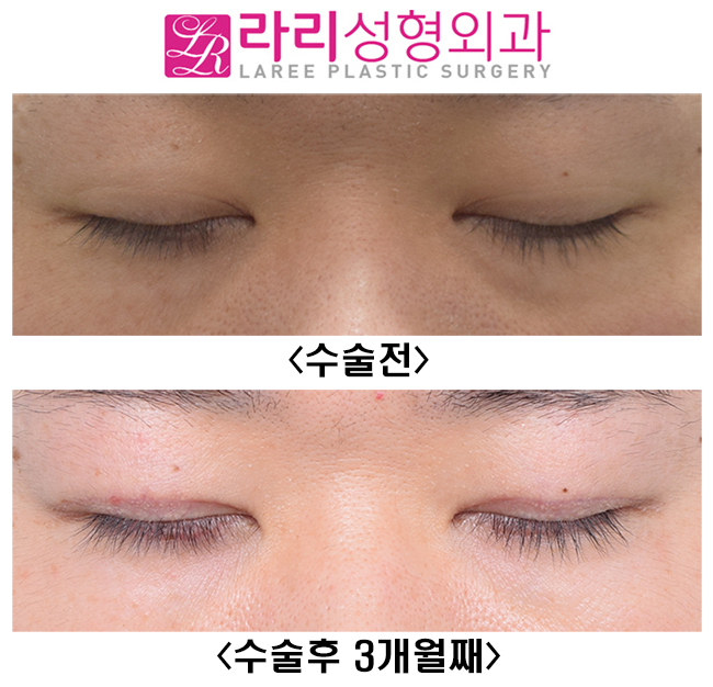 [Lari Plastic Surgery] Lowering the Line of Thick Natural Double Eyelids to a Deep-Eye Style That Looks Like No Double Eyelids image 2