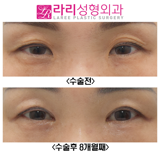 [라리성형외과] 여자도 하는 쌍꺼풀없애는수술, 앞트임수술과 찰떡 관련 이미지 1