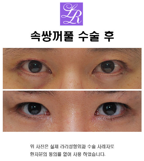 쌍꺼풀만들기 - 쌍액, 쌍테, 쌍수 뭘 해야하죠? 관련 이미지 3