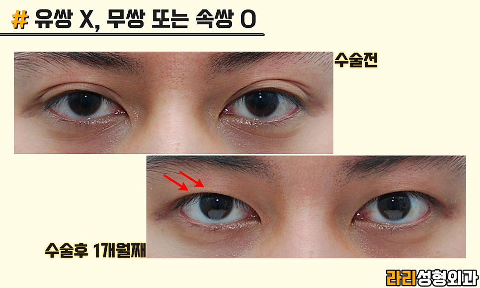 [Lari Plastic Surgery] Men’s Eye Surgery, Trends and Desired Look - Monolid & Hidden Double Eyelid image 2