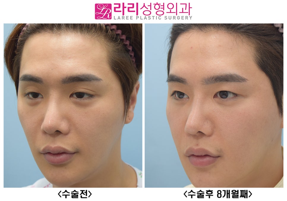 [라리성형외과] 여러겹 두꺼운 자연 쌍꺼풀 무쌍으로 풀기, 없애는 수술 관련 이미지 8