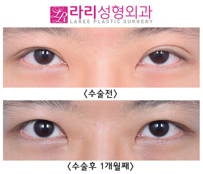 [라리성형외과] 쌍꺼풀없애는수술 한 달 차, 효과와 경과가 이 정도라고요?! 관련 이미지 1