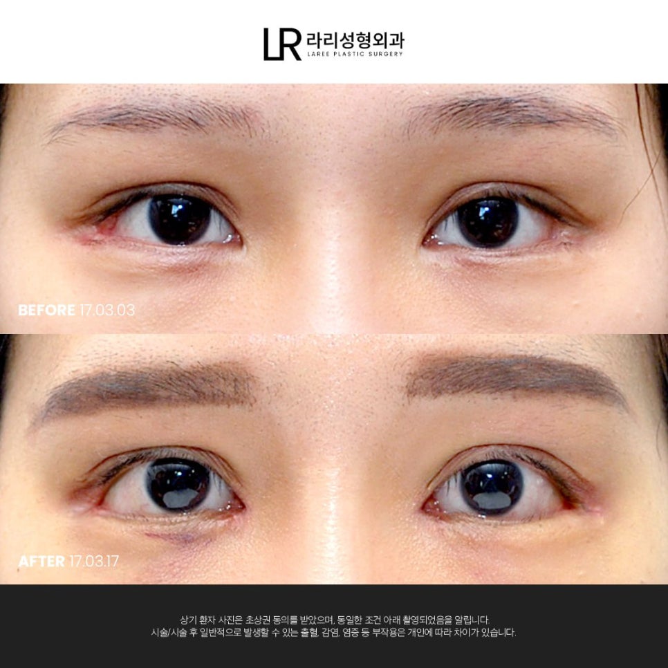 [라리성형외과] 여러 모양의 앞트임 흉터가 고민이라면 관련 이미지 2