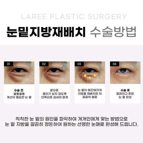 [라리성형외과] 하안검성형 VS 눈밑지방재배치(제거) : 어떤 수술을 해야 할까? 관련 이미지 9