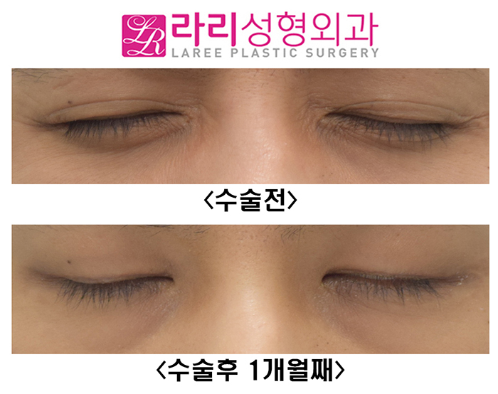 [라리성형외과] 눈크기 짝짝이 교정 수술 전후사진 관련 이미지 5