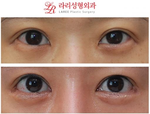 ☆Outer Eye Corner Lowering Lateral Canthoplasty / Revision Lateral Canthoplasty Long-Term Results 3 Years 2 Months Before-and-After Photos☆ image 1