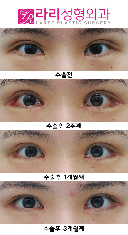 눈재수술  원인을 찾아서 ! (쌍재, 앞재, 뒤재로 해결) 관련 이미지 1