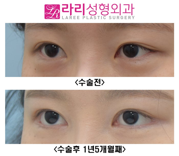 [라리성형외과] 눈이 확실히 커지는 눈 성형수술 3종 세트 (쌍수, 앞트임, 뒤트임) 관련 이미지 3