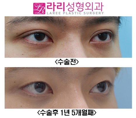 [Lari Plastic Surgery] Removing a Thick Natural Double Eyelid on Men image 2