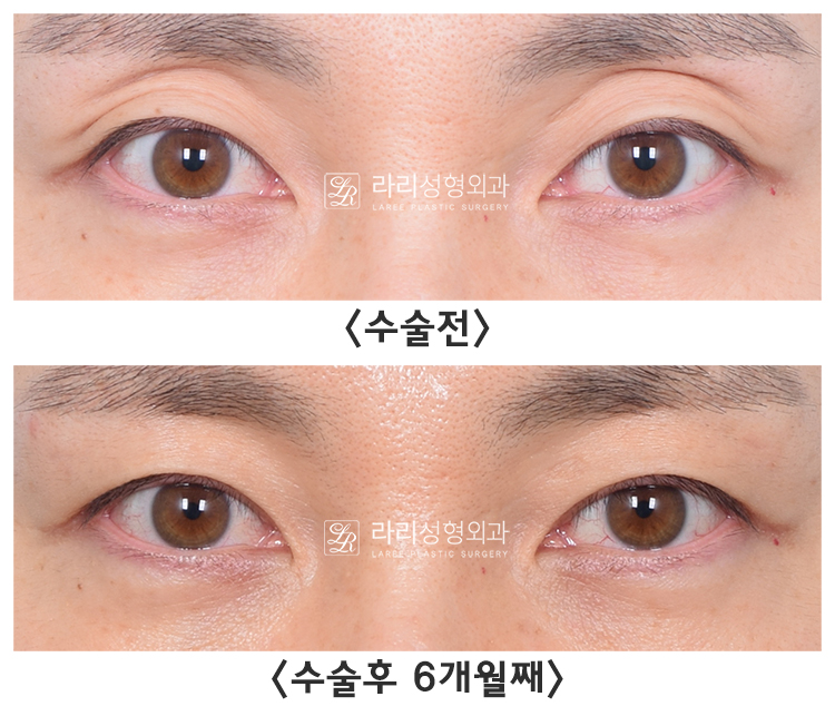 [라리성형외과] 아이홀 꺼짐 있는 눈 파악하고, 윗눈꺼풀 지방이식으로 교정 관련 이미지 11