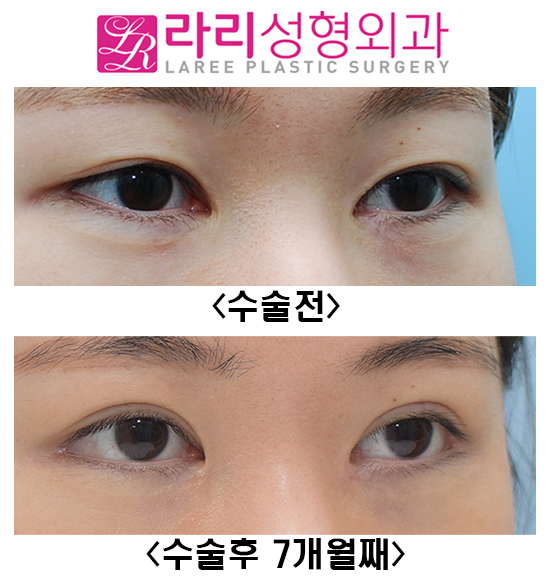 [라리성형외과] 쌍꺼풀재수술, 앞트임복원, 뒤트임재수술, 눈밑지방재배치재수술 전후 관련 이미지 5