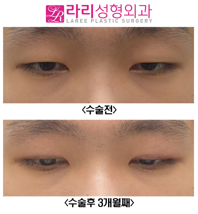 [라리성형외과] 남자 절개눈매교정 무쌍눈매교정 관련 이미지 4